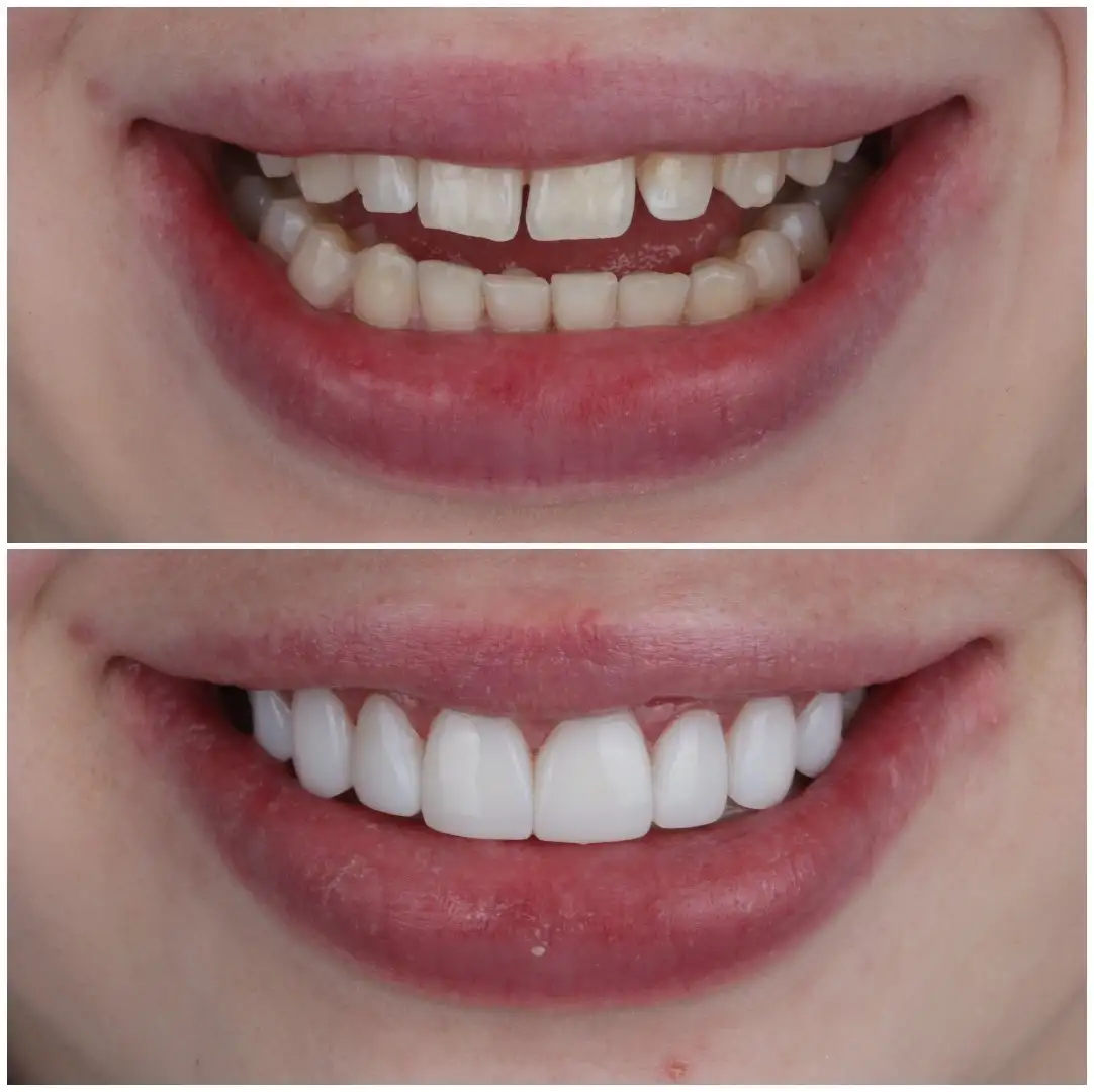 Diseño de Sonrisa