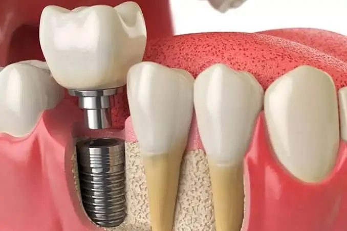 Implantes
